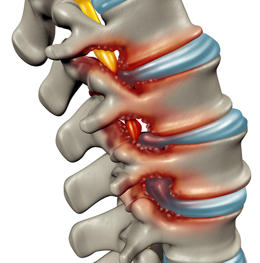 Cervical Spinal Stenosis - The Orthopedic Pain Institute, Beverly Hills  Pain Management Specialist