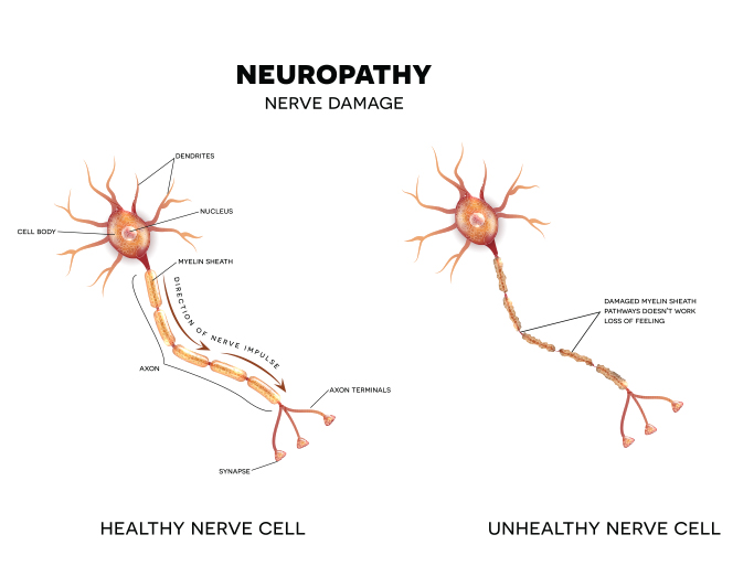 Neuropathic Pain Peripheral Neuropathy Pain The Orthopedic Pain 