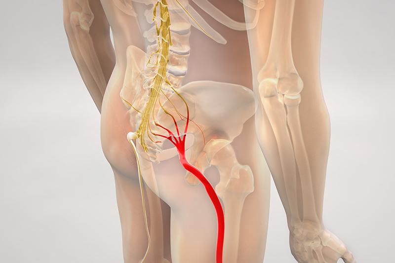 Piriformis Syndrome - A Real Pain in the Butt!